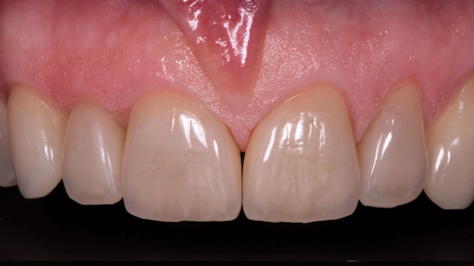 keramik-veneers-nachher