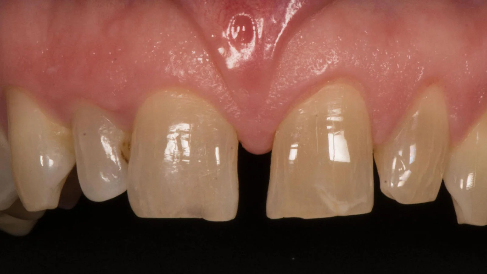keramik-veneers-vorher