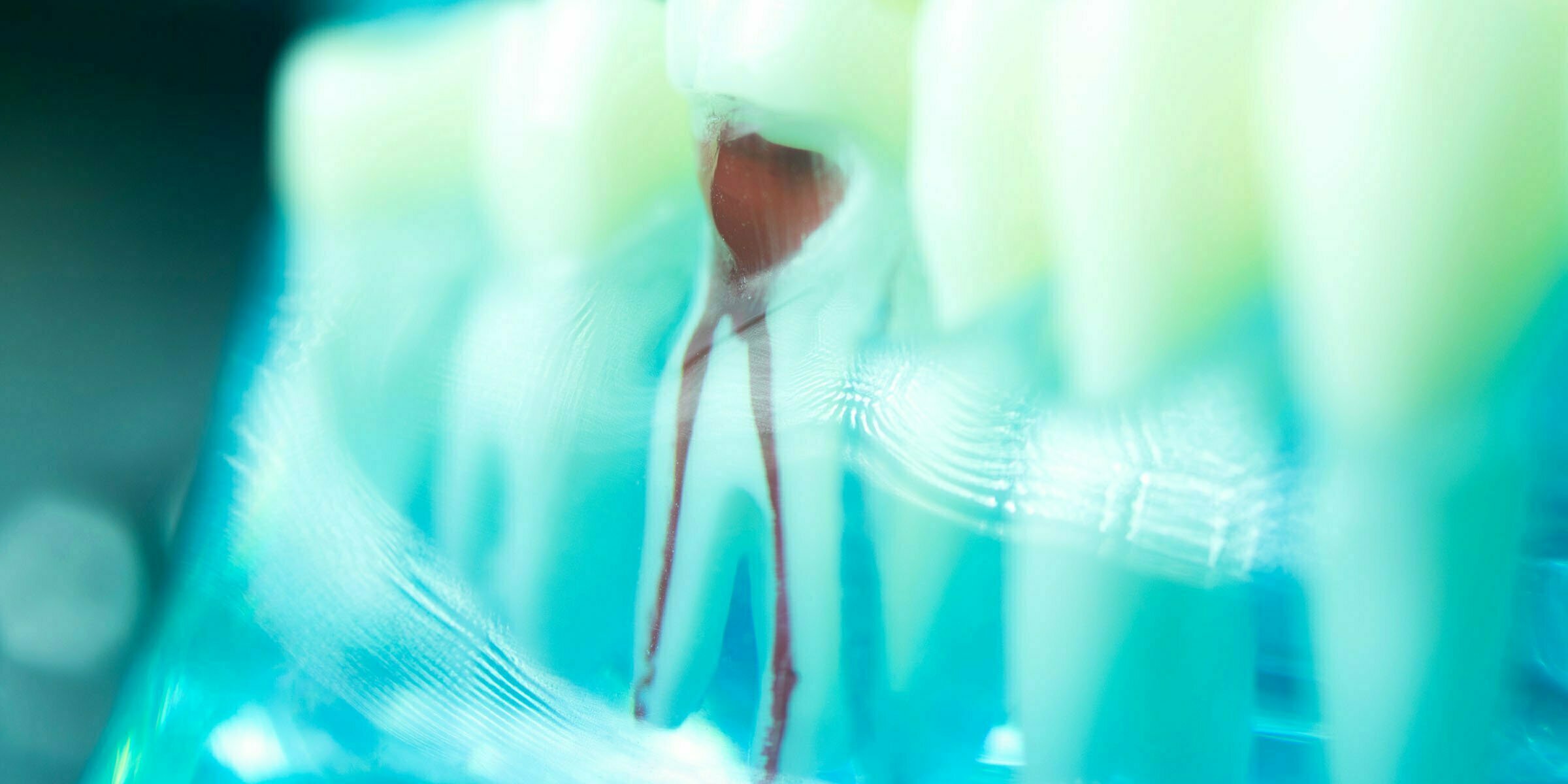 Zahnrettung durch Wurzelbehandlung - Zahnarztpraxis Dr. Köttgen in Mainz