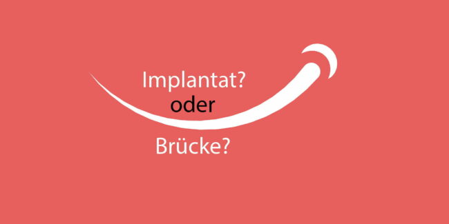 implantat-oder-bruecke