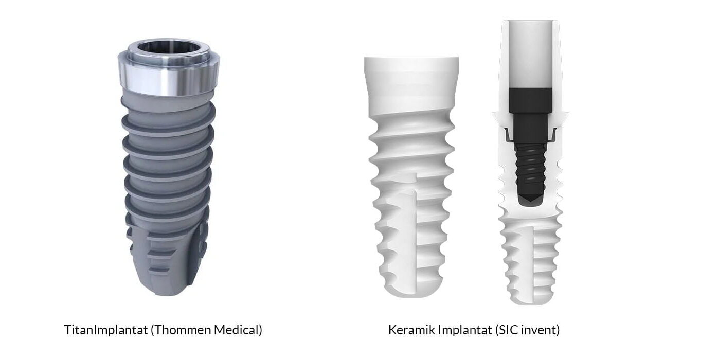 implantattypen-drkoettgen