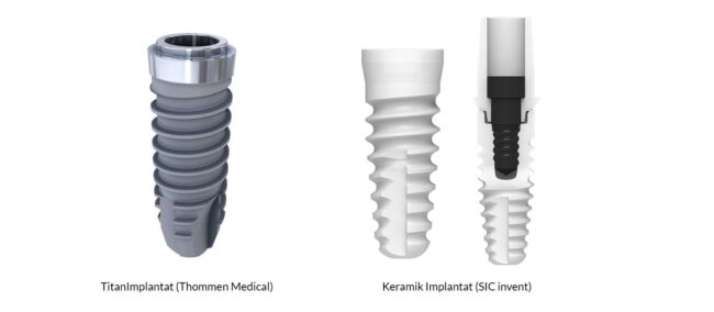 implantattypen-drkoettgen